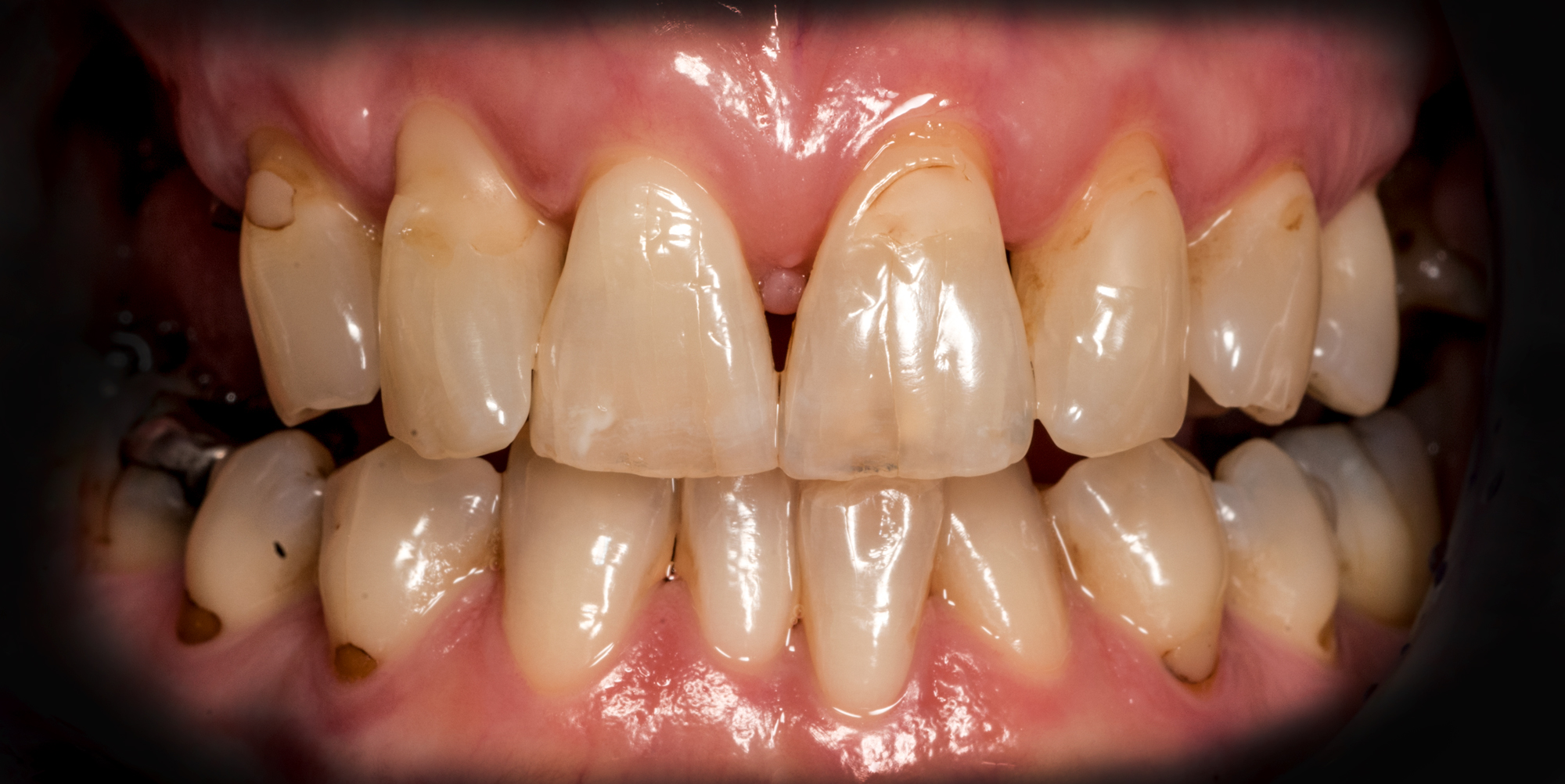 _RCW8063-A Natural-Dentition ron winter of fabulous teeth @ seaside dental laboratory & clinic Takapuna Auckland New Zealand.jpg