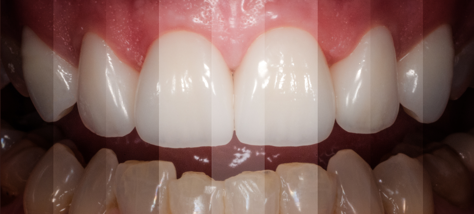 Horozontal-Stripped-Image-of-Six-Anterior-Crowns  ron winter of fabulous teeth @ seaside dental laboratory & clinic Takapuna Auckland New Zealand.jpg