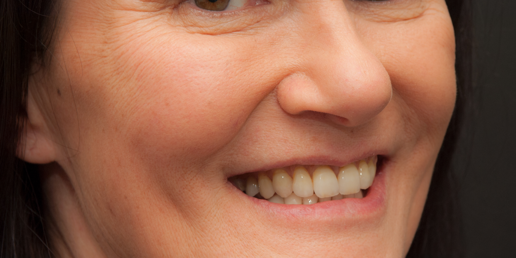 RCW7528 Natural Full Upper Denture by Ron Winter of Seaside Dental Laboratory & Clinic Takapuna Auckland NZ .jpg