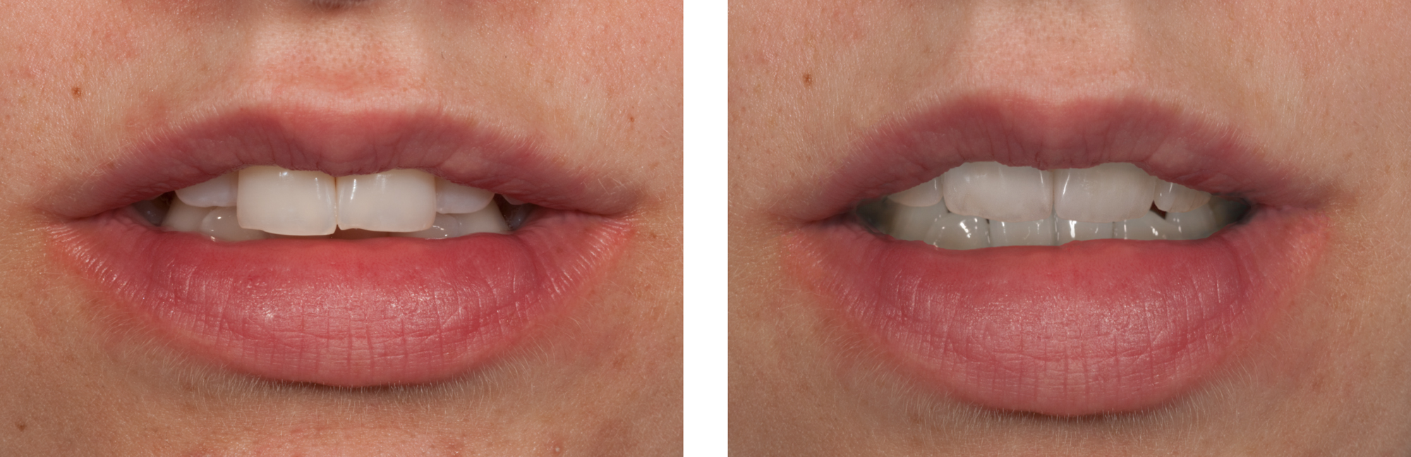 Before--After four Front Teeth by Ron Winter of Fabulous Teeth @ Seaside Dental Laboratory & Clinic Takapuna Auckland New Zealand.jpg