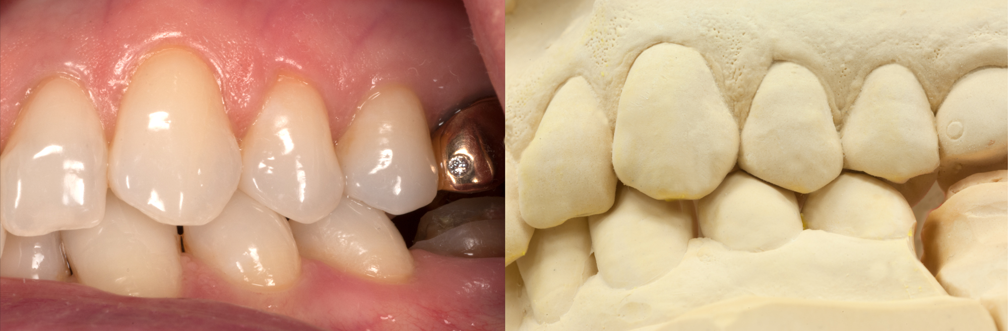 Val-Real-v-Model  ron winter of fabulous teeth @ seaside dental laboratory & clinic Takapuna Auckland New Zealand.jpg
