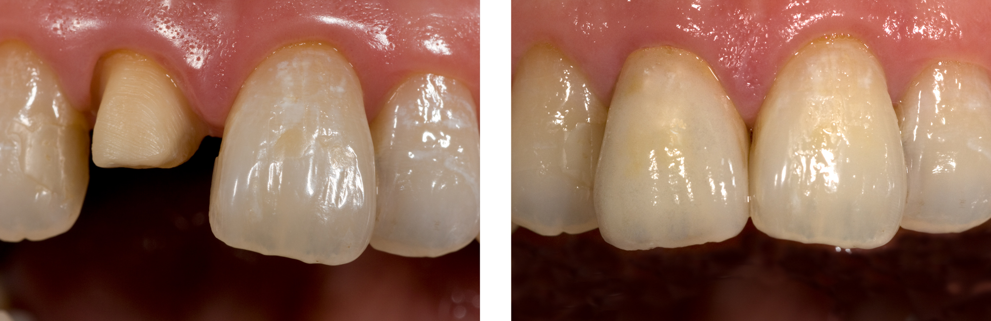 Single-Central-James-Wong-Ian-Chen-B--A by Ron Winter of Fabulous Teeth @ Seaside Dental Laboratory & Clinic.jpg
