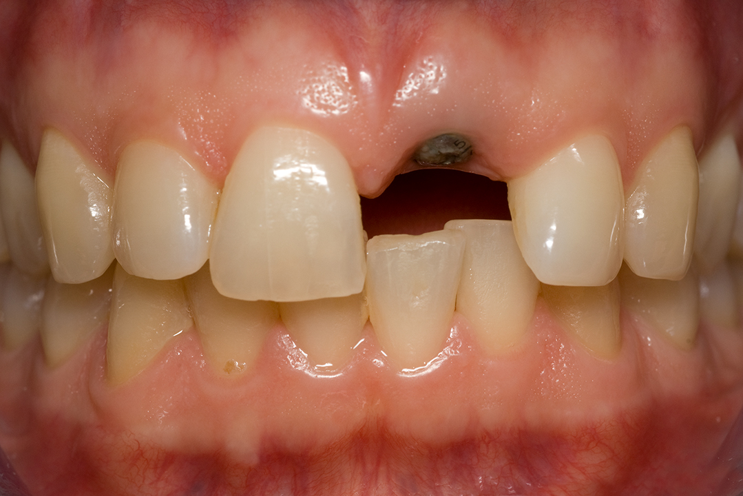 Implant_21_healing_cap_II.jpg