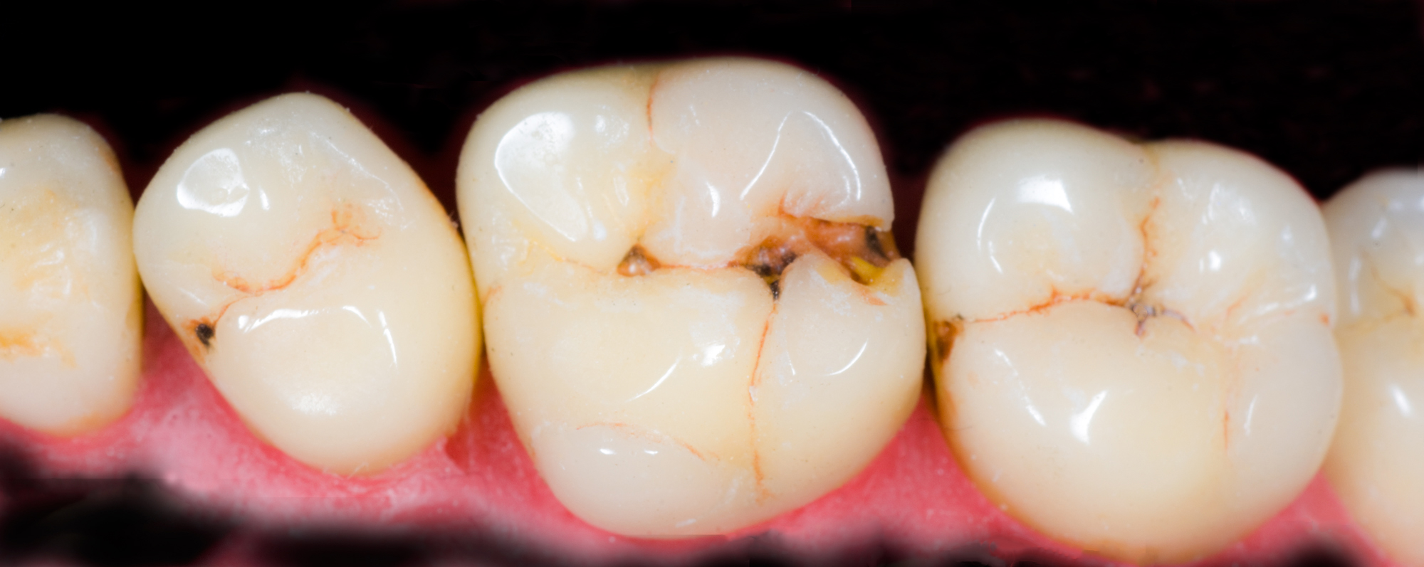 Ceramic-molars-Correctedron winter of fabulous teeth @ seaside dental laboratory & clinic Takapuna Auckland New Zealand.jpg