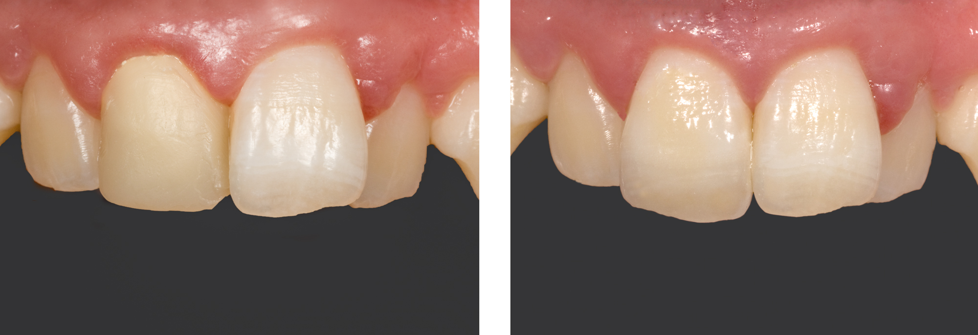 Single Front Tooth by Ron Winter of Fabulous Teeth @ Seaside Dental Laboratory Takapuna Auckland New Zealand.jpg
