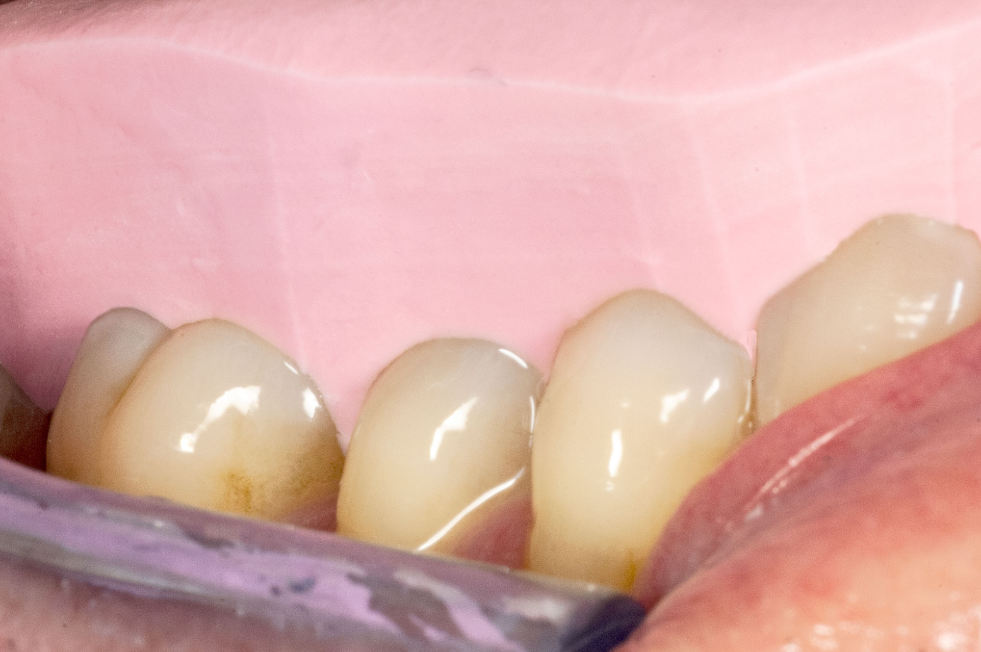 _RCW1873-Putty-Verification-in-placeron winter of fabulous teeth @ seaside dental laboratory & clinic Takapuna Auckland New Zealand.jpg