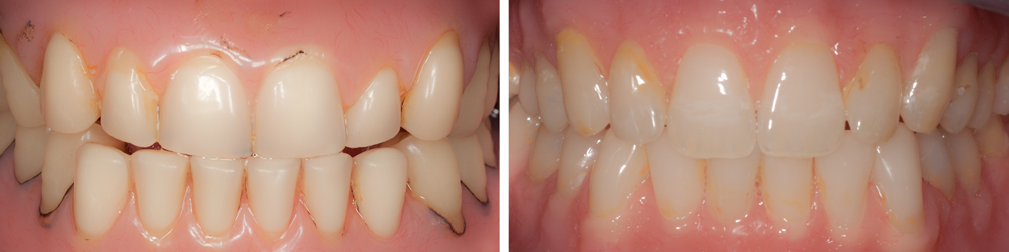 JA-Before-n-After-V2.jpg Fabulous Teeth & Ron Winter can change your life